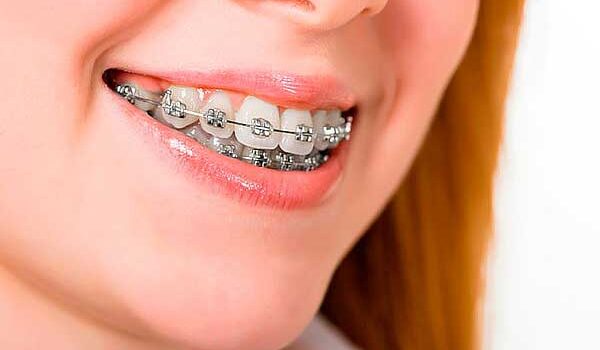 خدمات ارتودنسی ثابت در تبریز | درمان تخصصی با دکتر صدر