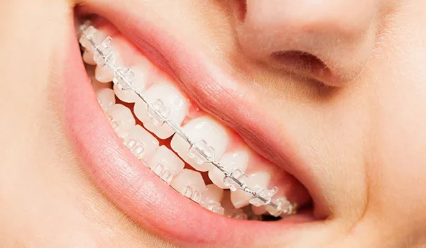 خدمات ارتودنسی سرامیکی در تبریز با بهترین امکانات