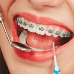 ردیف شدن دندانی در تبریز | لبخندی منظم