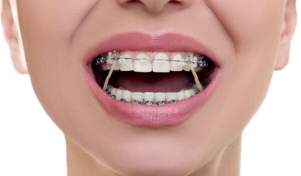 راهنمای جامع انتخاب متخصص ارتودنسی در تبریز